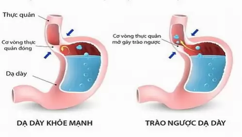 6 MẸO CHỮA ĐAU DẠ DÀY HIỆU QUẢ.