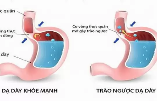 6 MẸO CHỮA ĐAU DẠ DÀY HIỆU QUẢ.
